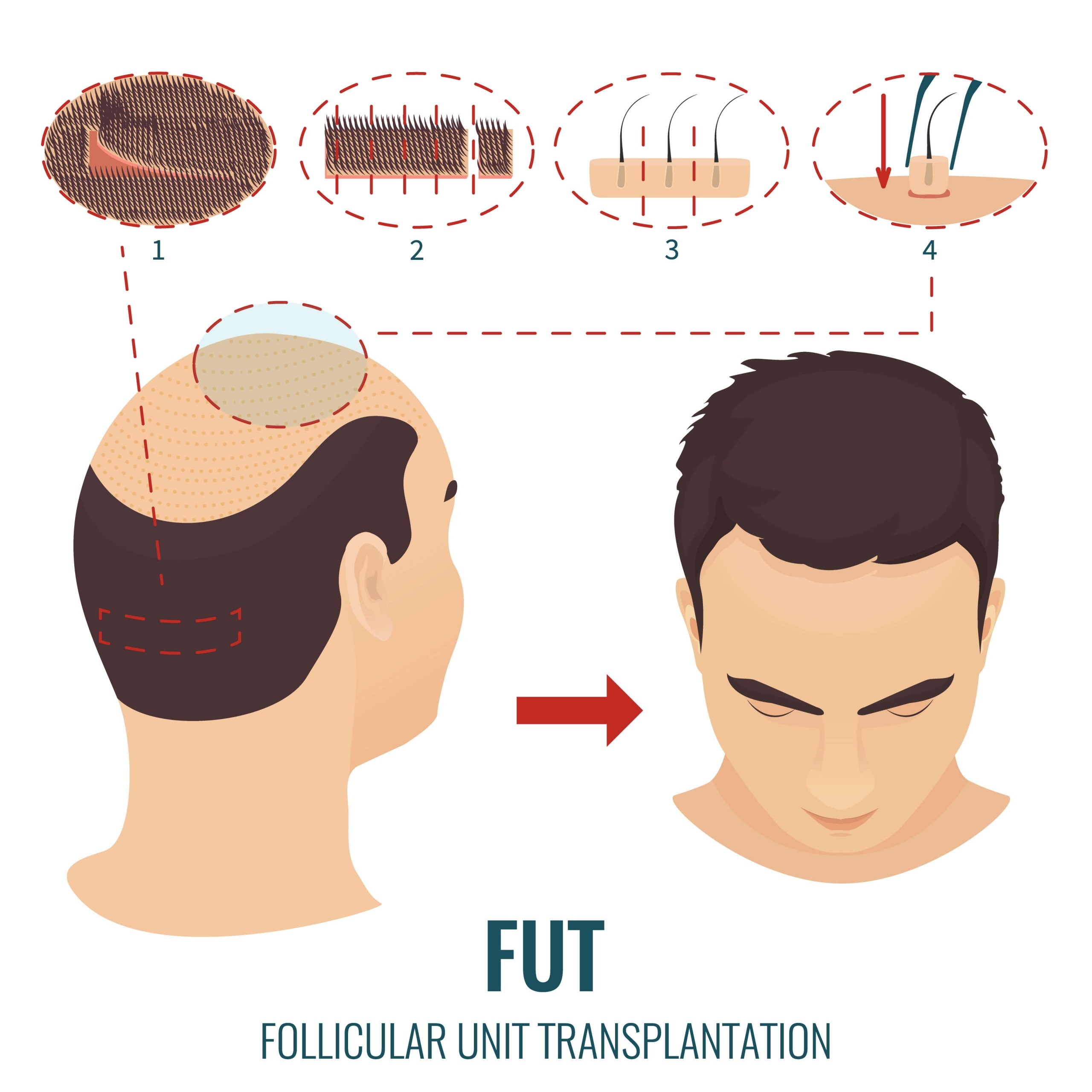 Haartransplantation FUT