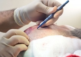 Vorbereiten der Haartransplantation
