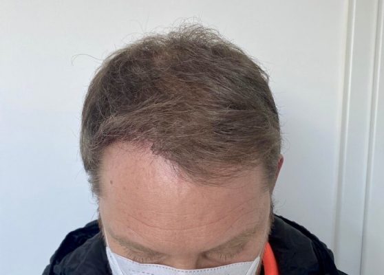 Erfolgreiche Haartransplantation bei VIVA Aesthetic Hair